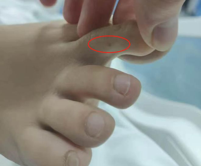 彩神网“三亚旅游被不明物咬伤身亡27岁女子”灭亡记载：曾诊断为不明生物咬伤(神经(图2)
